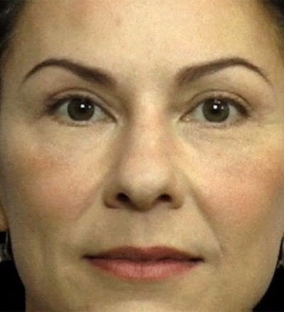 Eyelid Surgery Before & After Gallery - Patient 136520 - Image 2