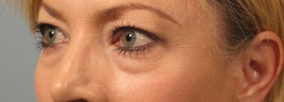 Eyelid Surgery Before & After Gallery - Patient 173460 - Image 1