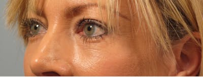 Eyelid Surgery Before & After Gallery - Patient 173460 - Image 2