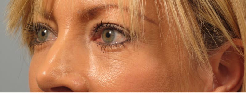 Eyelid Surgery Before & After Gallery - Patient 173460 - Image 2