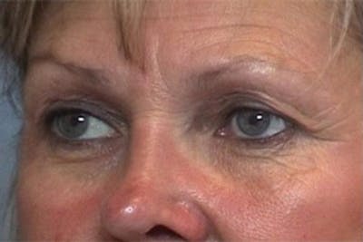 Eyelid Surgery Before & After Gallery - Patient 419154 - Image 1