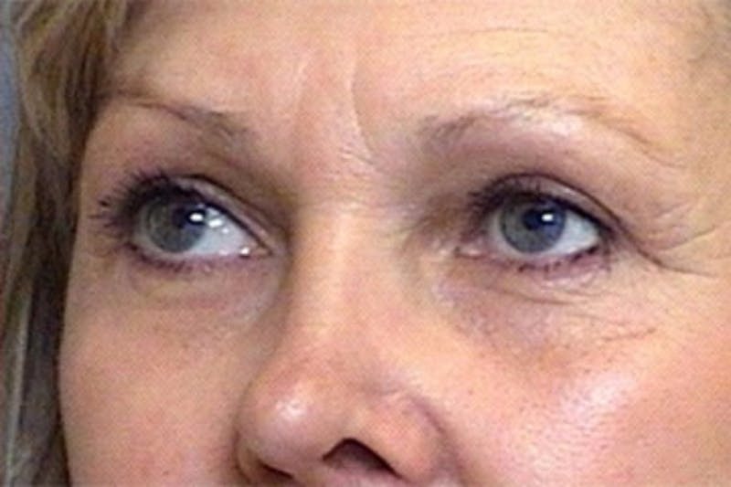 Eyelid Surgery Before & After Gallery - Patient 419154 - Image 2