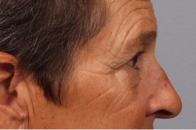 Eyelid Surgery Before & After Gallery - Patient 886918 - Image 1