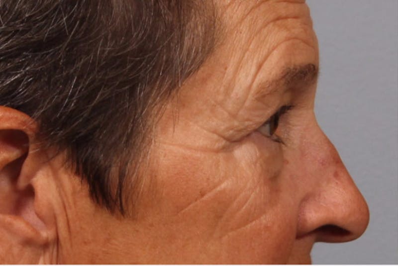 Eyelid Surgery Before & After Gallery - Patient 886918 - Image 1