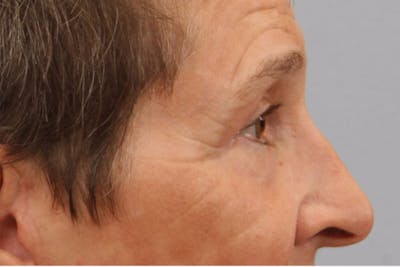 Eyelid Surgery Before & After Gallery - Patient 886918 - Image 2