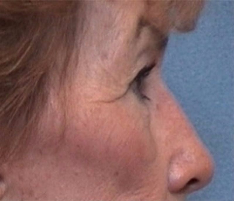 Eyelid Surgery Before & After Gallery - Patient 115361 - Image 1