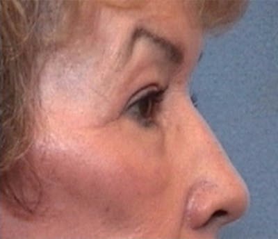 Eyelid Surgery Before & After Gallery - Patient 115361 - Image 2