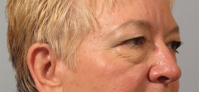 Eyelid Surgery Before & After Gallery - Patient 395215 - Image 1