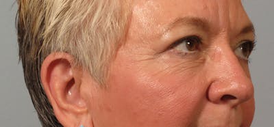 Eyelid Surgery Before & After Gallery - Patient 395215 - Image 2