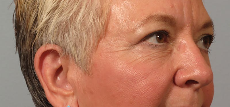 Eyelid Surgery Before & After Gallery - Patient 395215 - Image 2