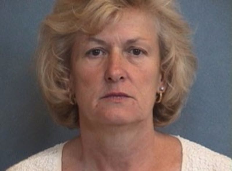 Facelift and Neck Lift Before & After Gallery - Patient 367919 - Image 1