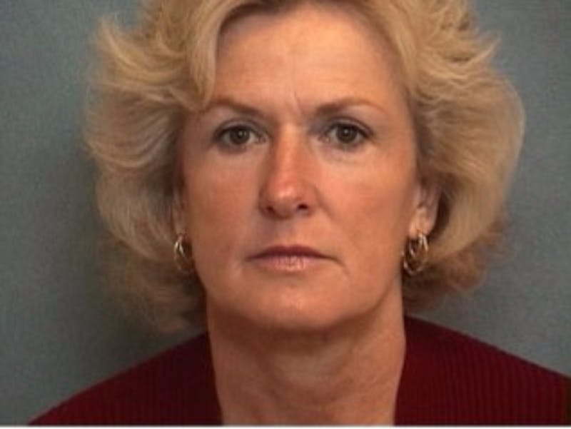 Facelift and Neck Lift Before & After Gallery - Patient 367919 - Image 2