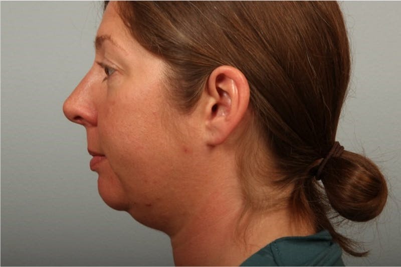 Facelift and Neck Lift Before & After Gallery - Patient 321258 - Image 1