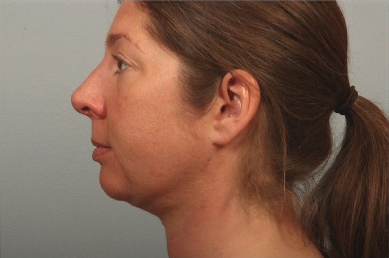 Facelift and Neck Lift Before & After Gallery - Patient 321258 - Image 2