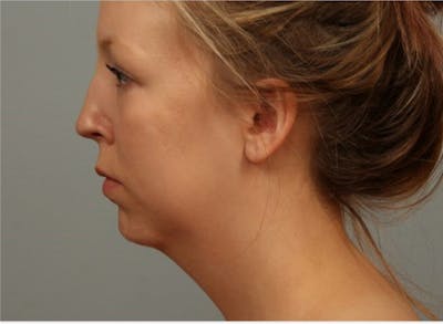 Facelift and Neck Lift Before & After Gallery - Patient 382334 - Image 1