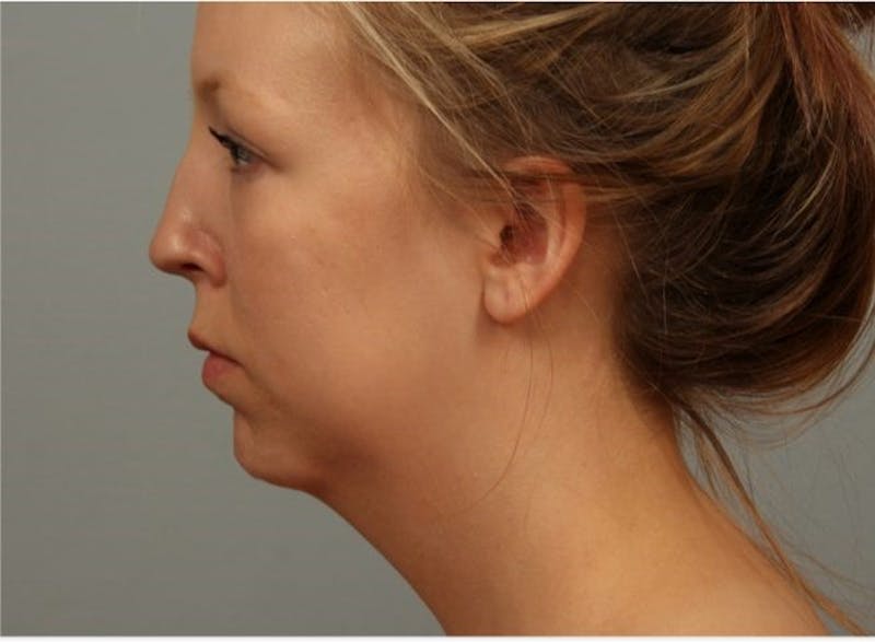 Facelift and Neck Lift Before & After Gallery - Patient 382334 - Image 1
