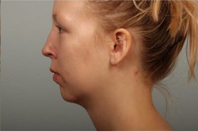 Facelift and Neck Lift Before & After Gallery - Patient 382334 - Image 2