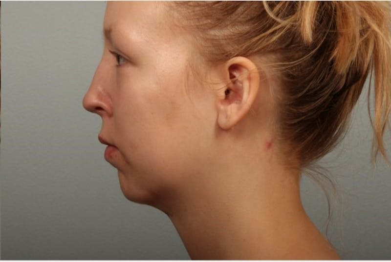 Facelift and Neck Lift Before & After Gallery - Patient 382334 - Image 2