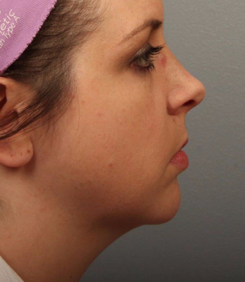Facelift and Neck Lift Before & After Gallery - Patient 385966 - Image 1