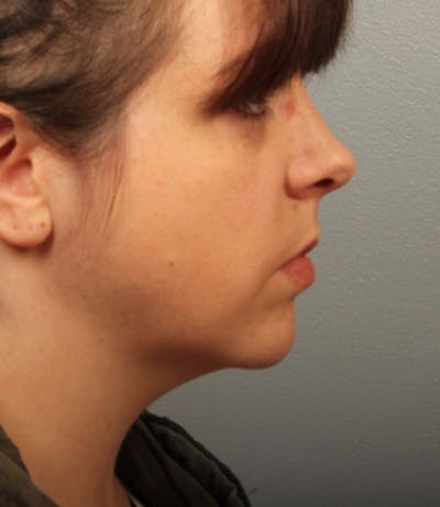 Facelift and Neck Lift Before & After Gallery - Patient 385966 - Image 2