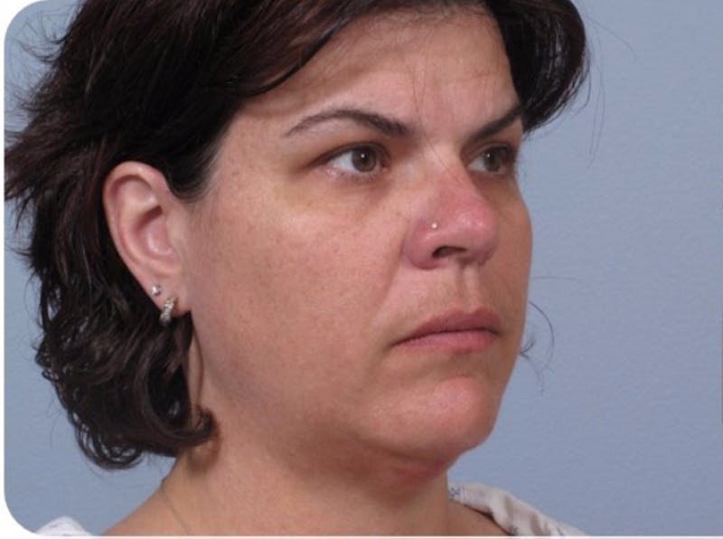 Facelift and Neck Lift Before & After Gallery - Patient 183420 - Image 1