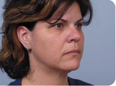 Facelift and Neck Lift Before & After Gallery - Patient 183420 - Image 2