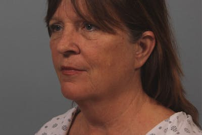 Facelift and Neck Lift Before & After Gallery - Patient 552052 - Image 1