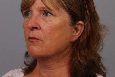 Facelift and Neck Lift Before & After Gallery - Patient 552052 - Image 2