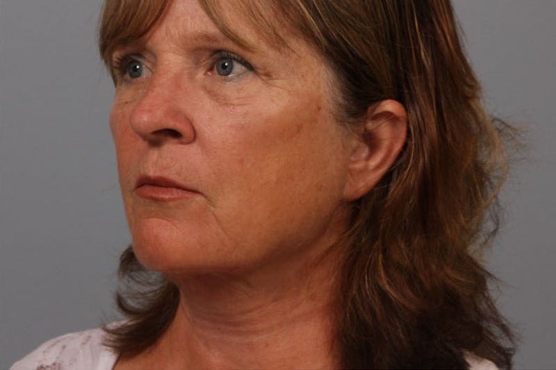 Facelift and Neck Lift Before & After Gallery - Patient 552052 - Image 2