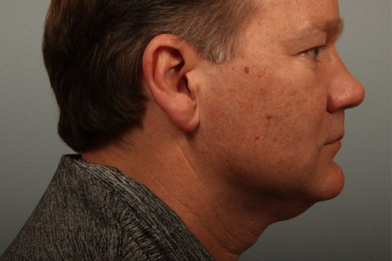 Facelift and Neck Lift Before & After Gallery - Patient 319107 - Image 1