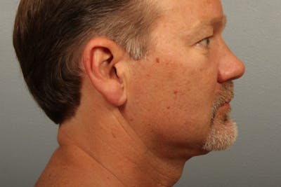 Facelift and Neck Lift Before & After Gallery - Patient 319107 - Image 2