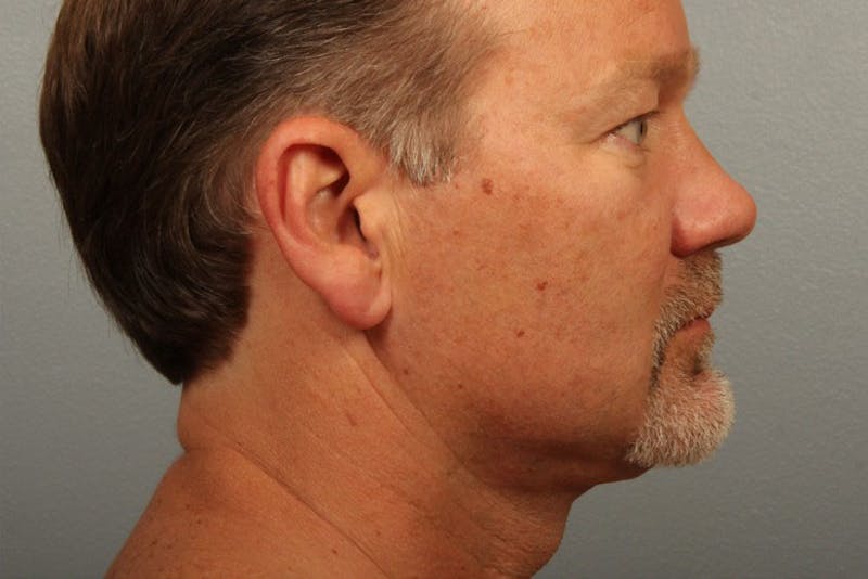Facelift and Neck Lift Before & After Gallery - Patient 319107 - Image 2