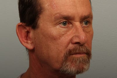 Facelift and Neck Lift Before & After Gallery - Patient 121751 - Image 1