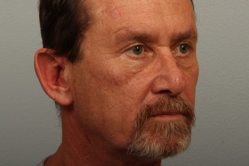 Facelift and Neck Lift Before & After Gallery - Patient 121751 - Image 1