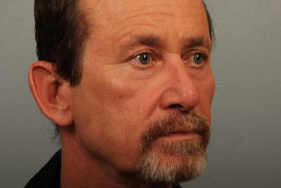 Facelift and Neck Lift Before & After Gallery - Patient 121751 - Image 2