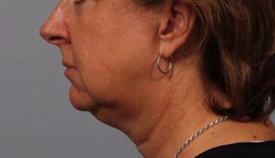 Facelift and Neck Lift Before & After Gallery - Patient 415030 - Image 1