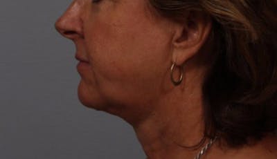 Facelift and Neck Lift Before & After Gallery - Patient 415030 - Image 2