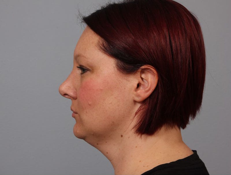 Facelift and Neck Lift Before & After Gallery - Patient 188286 - Image 1