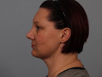 Facelift and Neck Lift Before & After Gallery - Patient 188286 - Image 2