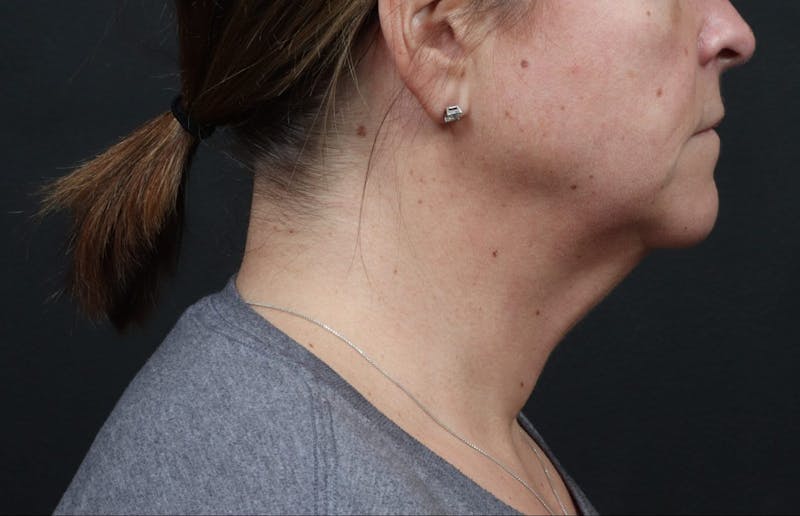 Necklift Before & After Gallery - Patient 111427 - Image 1