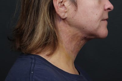 Necklift Before & After Gallery - Patient 111427 - Image 2
