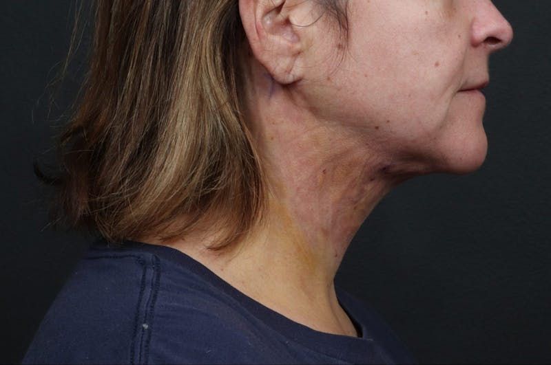 Necklift Before & After Gallery - Patient 111427 - Image 2