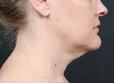 Necklift Before & After Gallery - Patient 288384 - Image 1