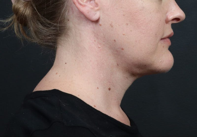 Necklift Before & After Gallery - Patient 288384 - Image 2