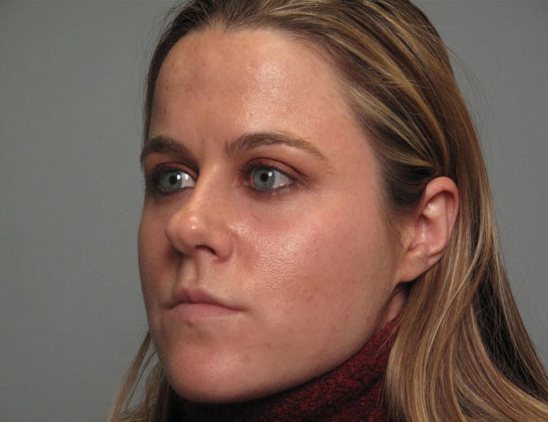 Rhinoplasty Before & After Gallery - Patient 745600 - Image 1