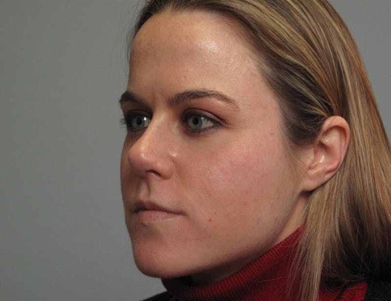 Rhinoplasty Before & After Gallery - Patient 745600 - Image 2