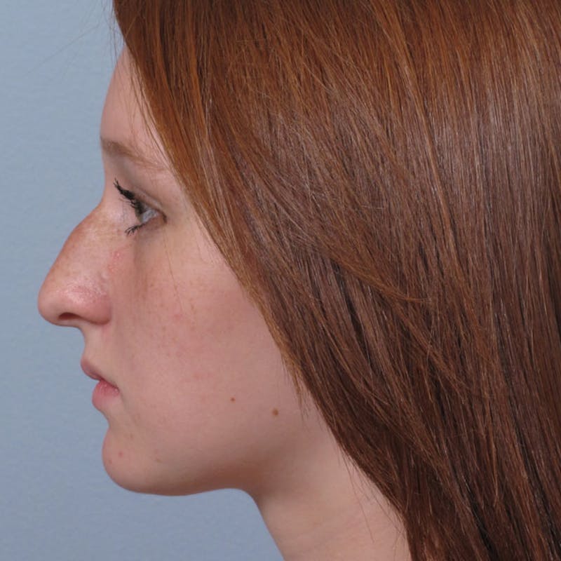 Rhinoplasty Before & After Gallery - Patient 236524 - Image 1