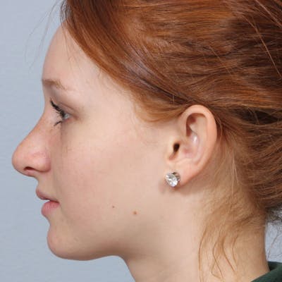 Rhinoplasty Before & After Gallery - Patient 236524 - Image 2