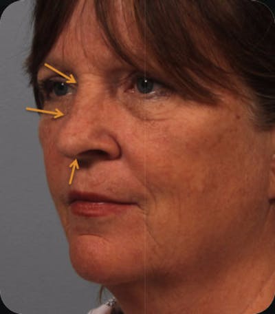 Rhinoplasty Before & After Gallery - Patient 295138 - Image 1