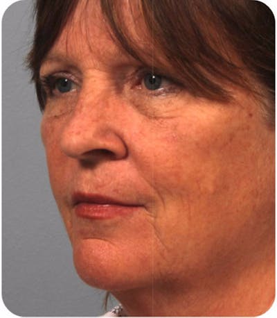 Rhinoplasty Before & After Gallery - Patient 295138 - Image 2